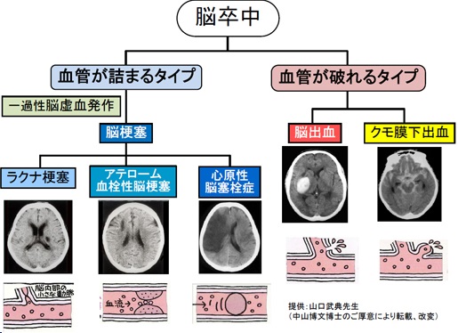 脳卒中,種類,脳梗塞,ラクナ梗塞,アテローム血栓性脳梗塞,心原性脳塞栓症,脳出血,くも膜下出血