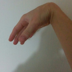 手根管症候群の自己検査：ファレンテスト