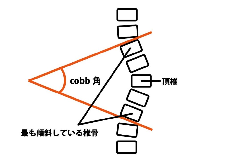 Cobb角