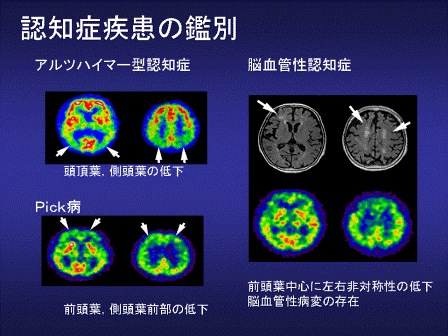脳血管性認知症のMRI画像所見