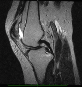 後十字靭帯(PCL)損傷 リハビリ|MRI