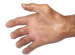 母指球筋の萎縮（猿手変形）