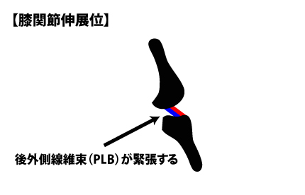 後外側線維束（PLB）