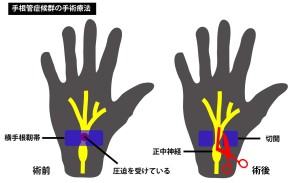 手根管症候群の治療