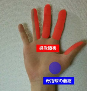 手根管症候群の症状①