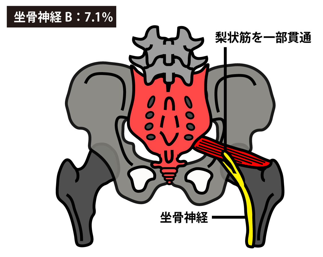 坐骨神経が梨状筋の一部を貫通する