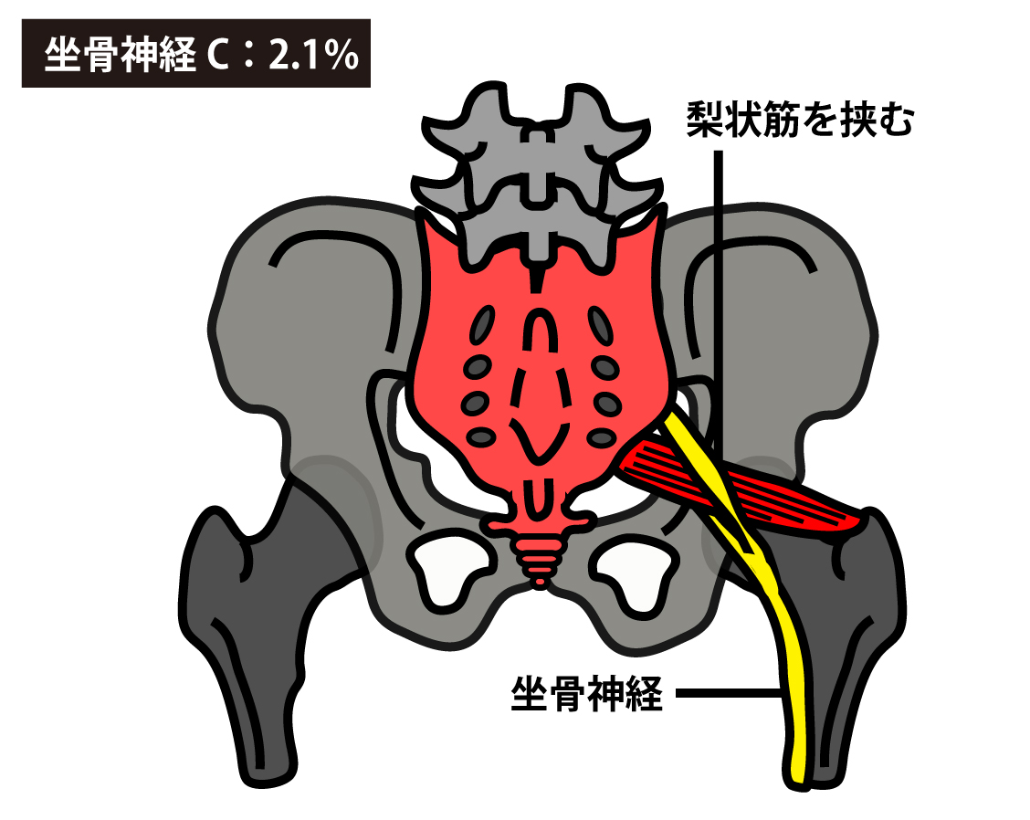 坐骨神経が梨状筋を挟んで通過する