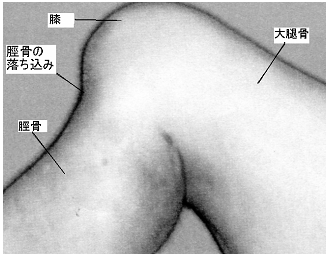 後十字靭帯 損傷 テスト|脛骨の後方落ち込み現象