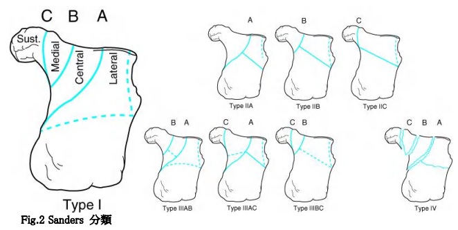 Sanders分類,踵骨骨折,リハビリ
