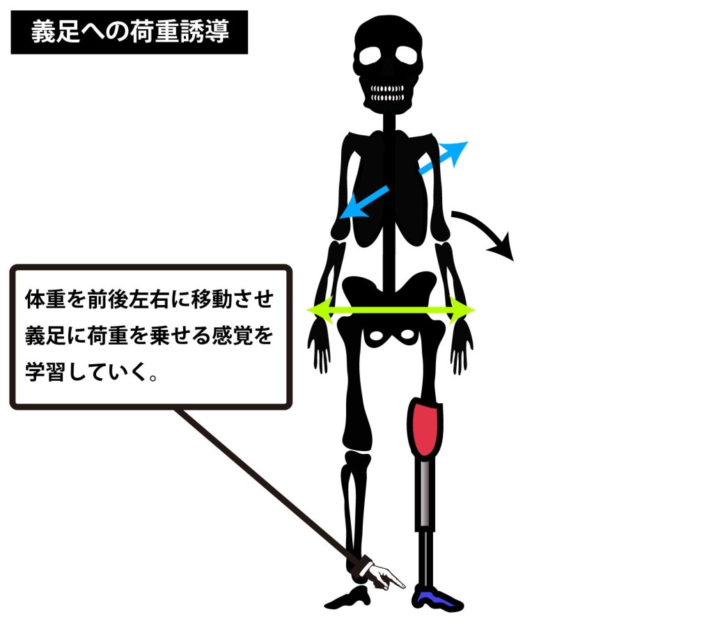 下肢切断｜義足への荷重誘導｜リハビリテーション