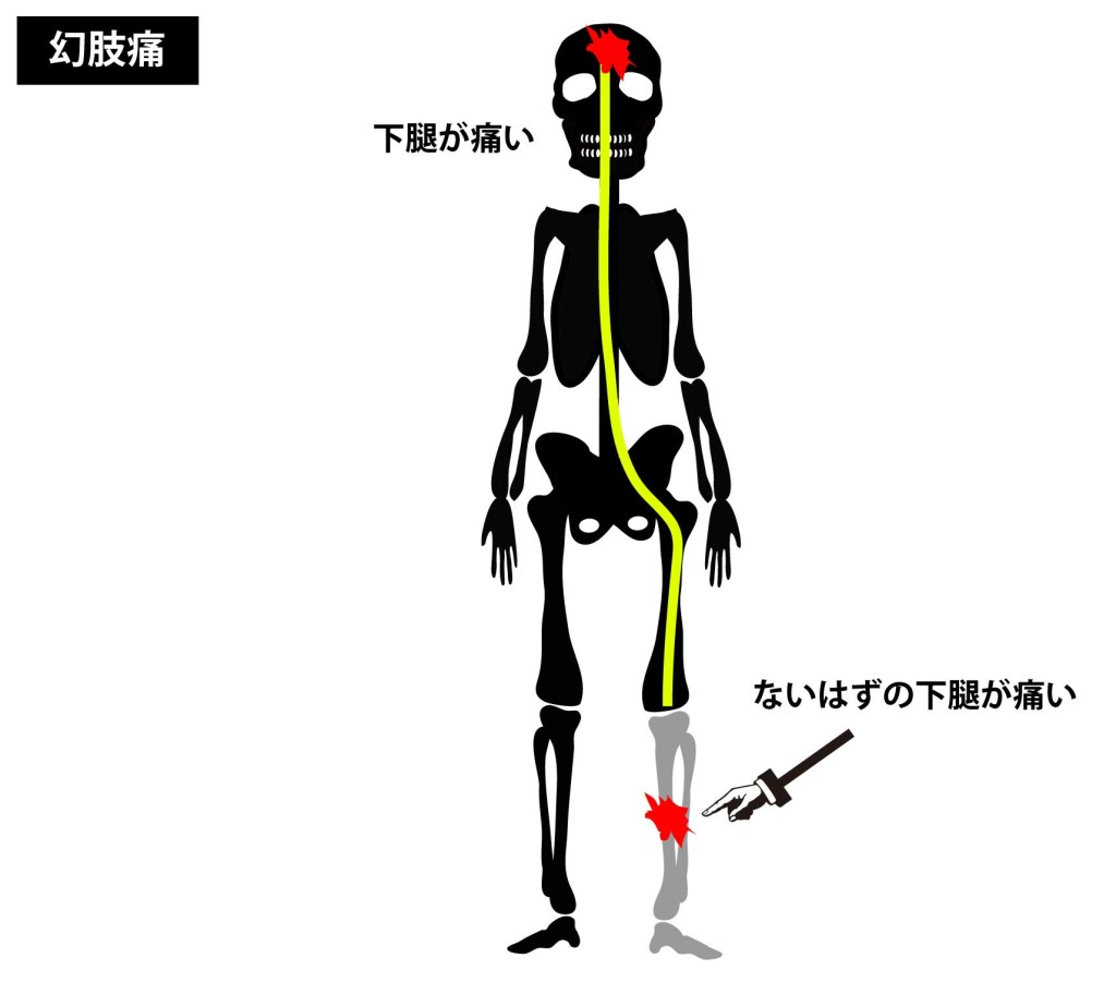 幻肢痛の原因メカニズム