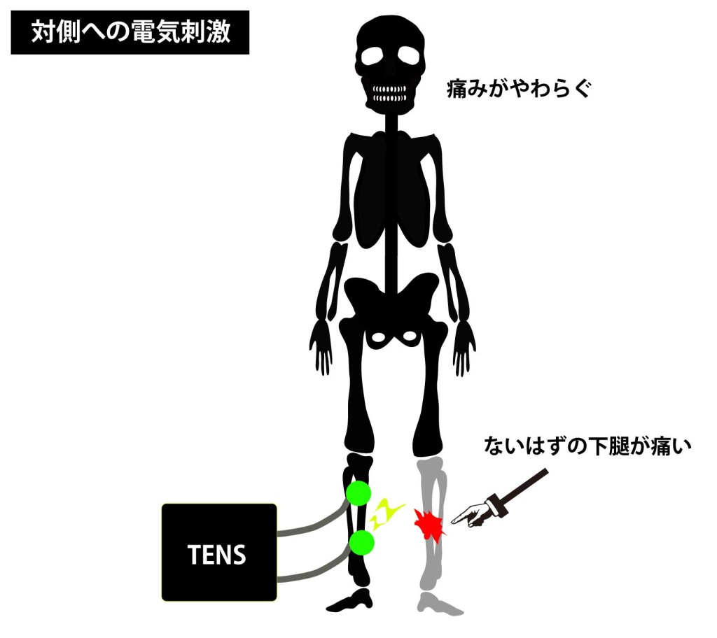幻肢痛の治療｜経皮的電気刺激TENS
