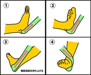 後足部回外誘導テーピング１