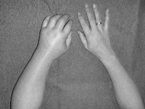 反射性交感神経ジストロフィー症/肩手症候群