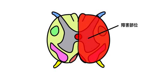 ブラウン・セカール障害