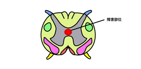 中心管付近の障害