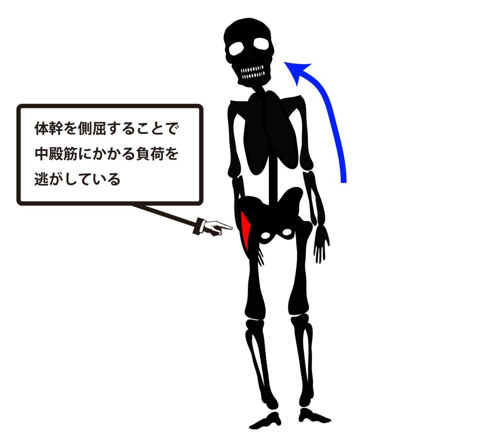 人工股関節置換術｜デュシェンヌ歩行