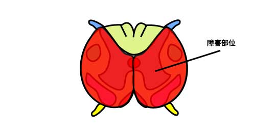 脊髄前半の障害