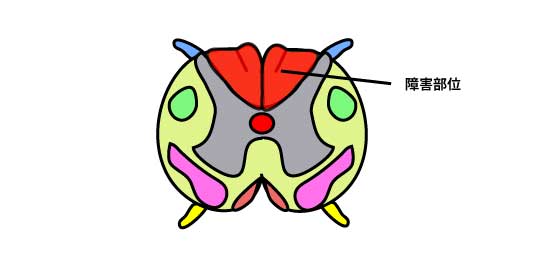 脊髄後索の障害