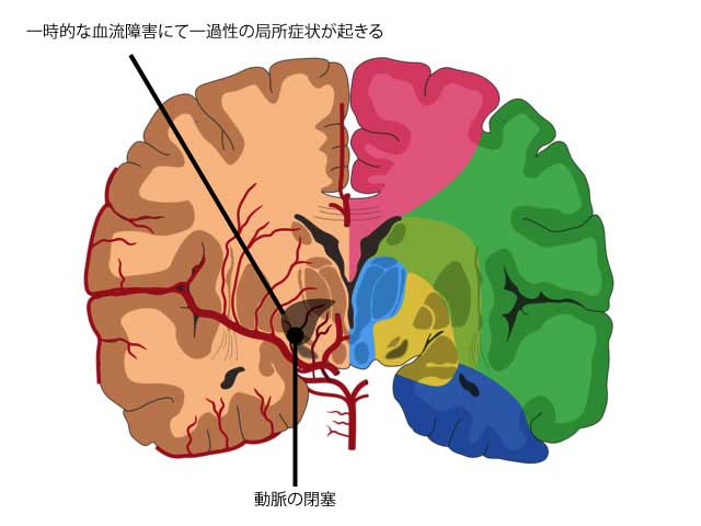 一過性脳虚血発作