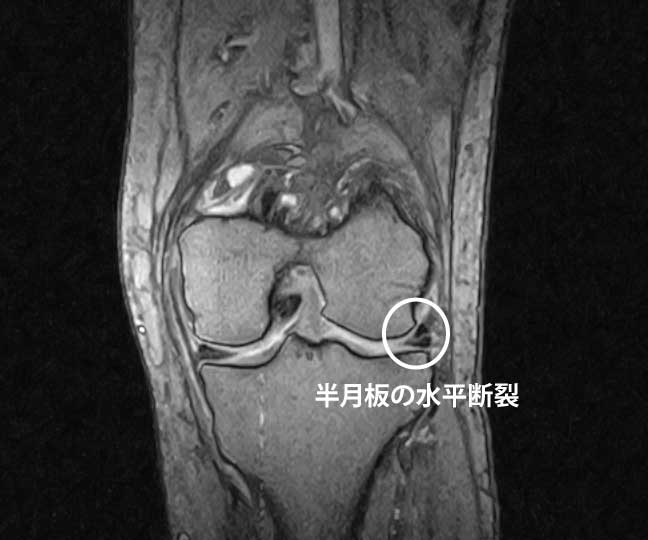 外側半月板の水平断裂