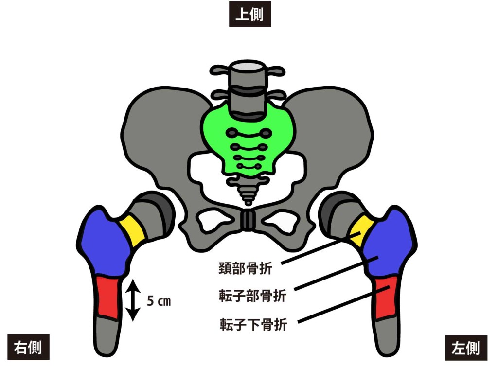 大腿骨頚部骨折