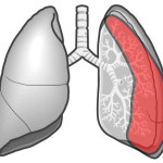 自然気胸の聴診部位