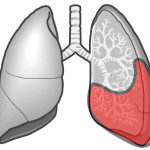 細かい断続性ラ音（捻髪音）の聴診部位