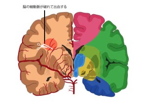 脳出血の図