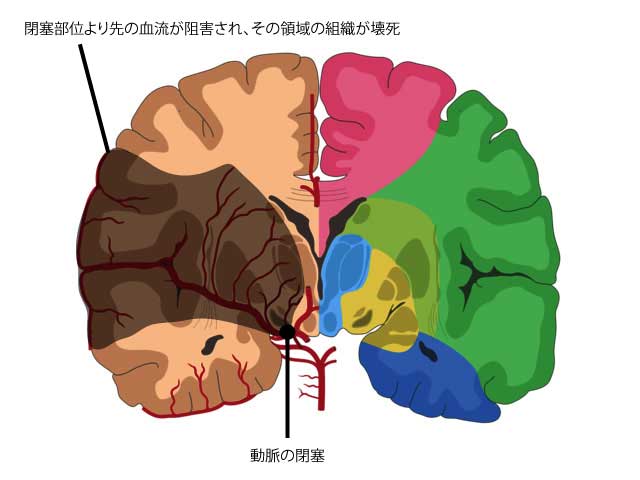 脳梗塞の図