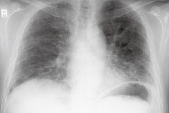 間質性肺炎の胸部X線画像