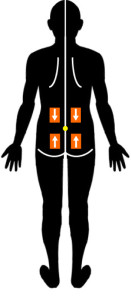 脊椎分離症に対するテーピング治療｜腰椎伸展可動域制限