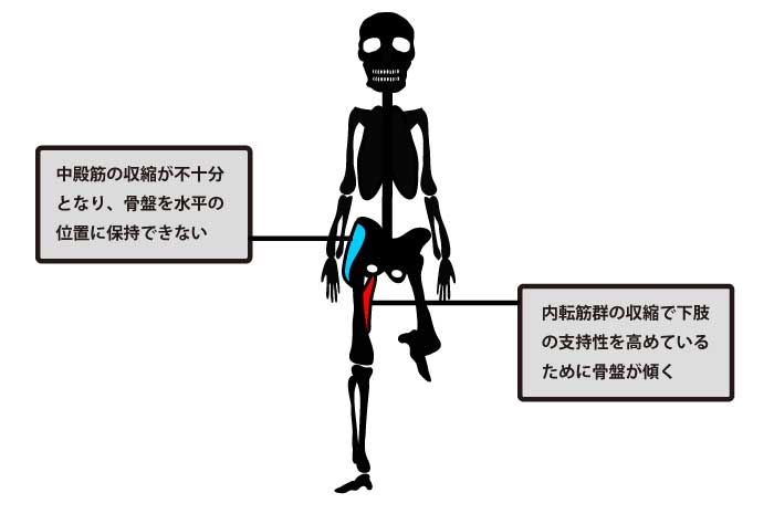 トレンデレンブルグ歩行と股関節内転筋