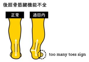 後脛骨筋腱機能不全