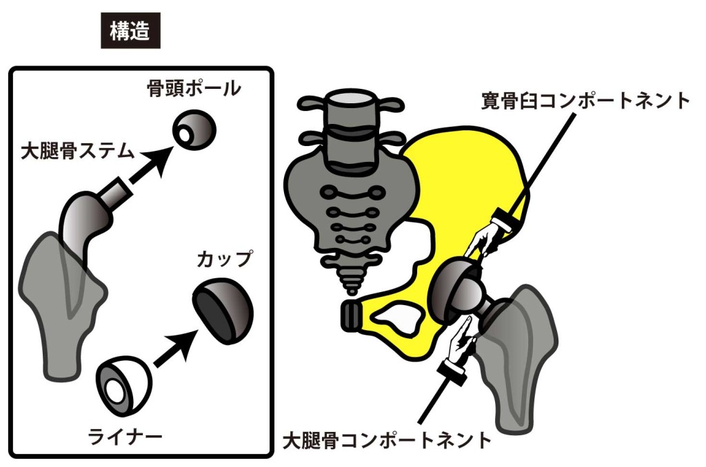人工股関節全置換術の構造
