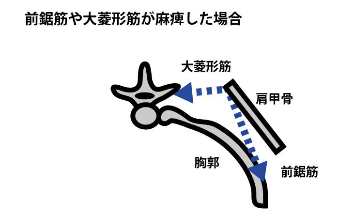 前鋸筋や大菱形筋が麻痺した場合|翼状肩甲