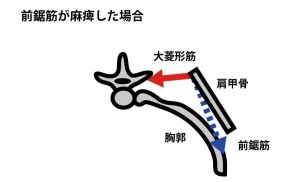 前鋸筋(長胸神経)が麻痺した場合|翼状肩甲