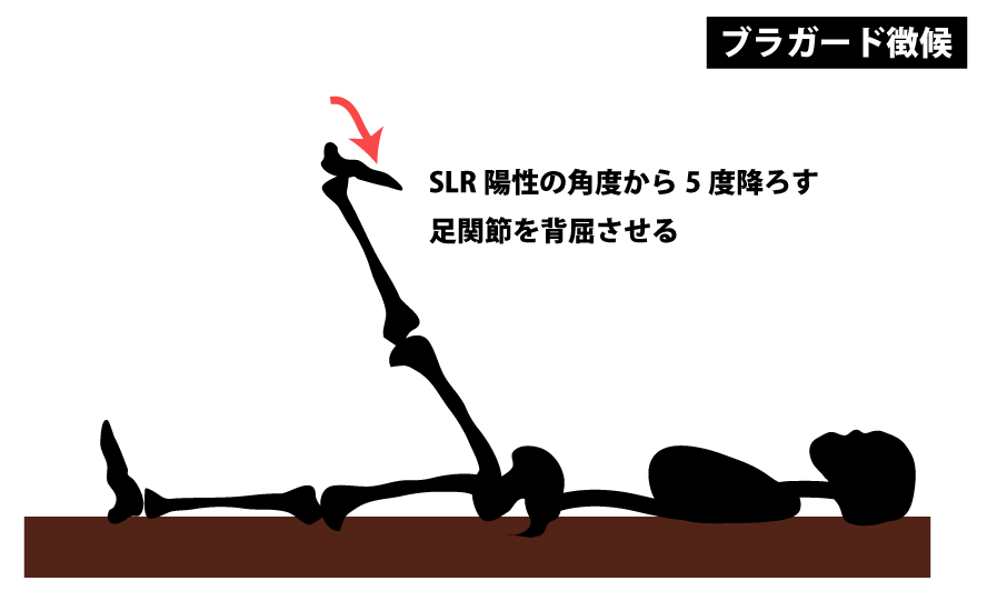 ブラガード徴候