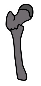 大腿骨転子下骨折｜Zickelの分類｜粉砕のある短い斜骨折