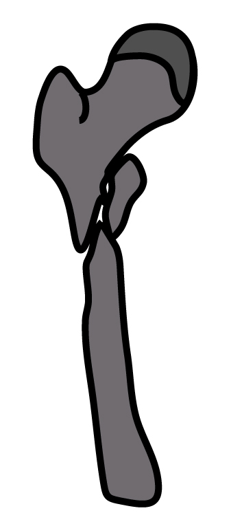 大腿骨転子下骨折｜Zickelの分類｜粉砕のある長い斜骨折