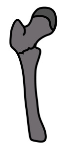 大腿骨転子下骨折｜Zickelの分類｜粉砕のない短い斜骨折