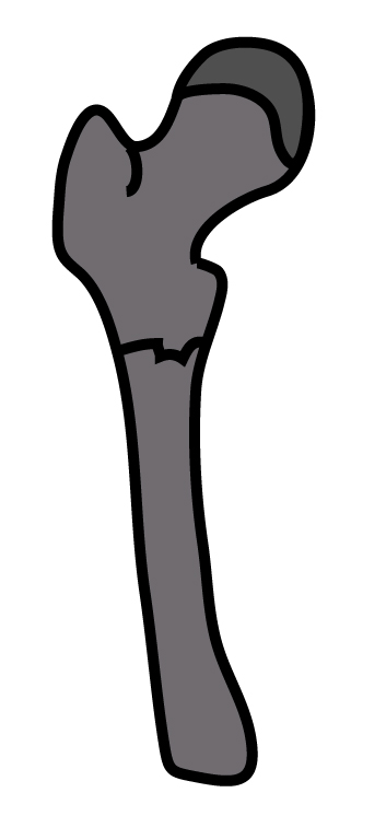 大腿骨転子下骨折｜Zickelの分類｜近位の横骨折