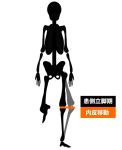 変形性膝関節症｜歩行姿勢｜ラテラルスラスト歩行