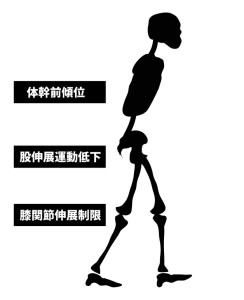 変形性膝関節症｜歩行姿勢｜膝関節伸展制限
