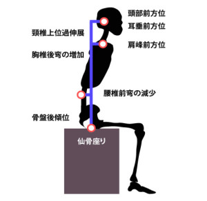座位姿勢のアライメント｜不良姿勢