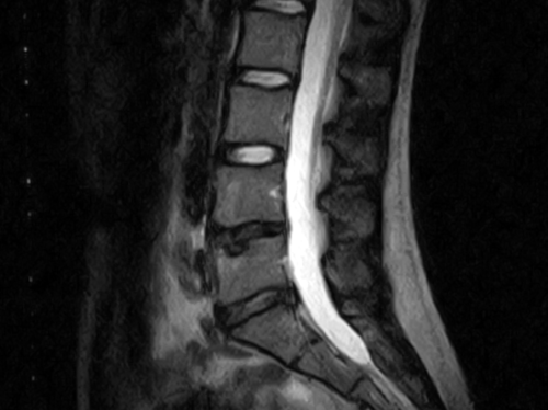 シュモール結節MRI画像