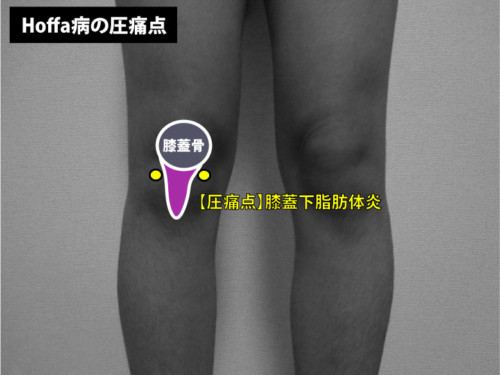 Hoffa病 膝蓋下脂肪体炎の圧痛点 Rehatora Net