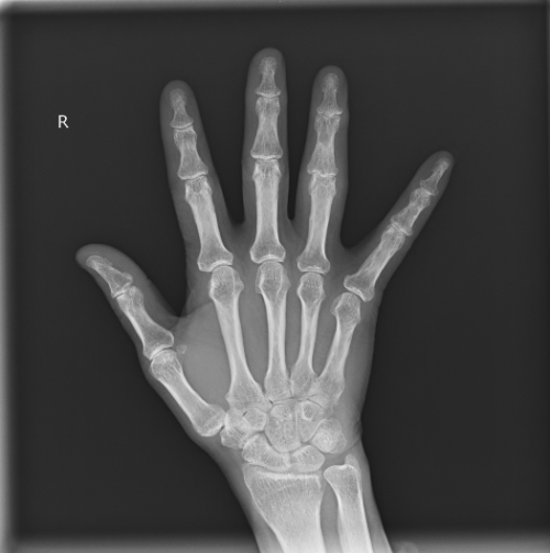 変形性指関節症