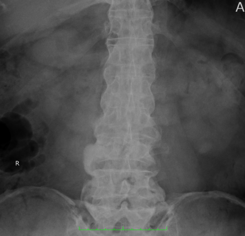 強直性脊椎炎｜後面
