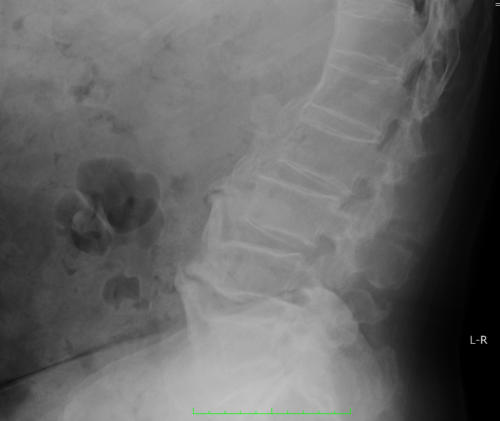 強直性脊椎炎｜脊椎側面